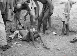 Concerned people (include at least to American GIs) surround a sick Chinese youth. The were many sick and weakened during the Chinese civilian evacuation in Liuzhou city, Guangxi province, China, during WWII, in the summer or fall of 1944 as the Japanese swept through as part of the large Ichigo push.