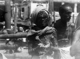 Man disfigured by skin disease.  Scenes in India witnessed by American GIs during WWII. For many Americans of that era, with their limited experience traveling, the everyday sights and sounds overseas were new, intriguing, and photo worthy.